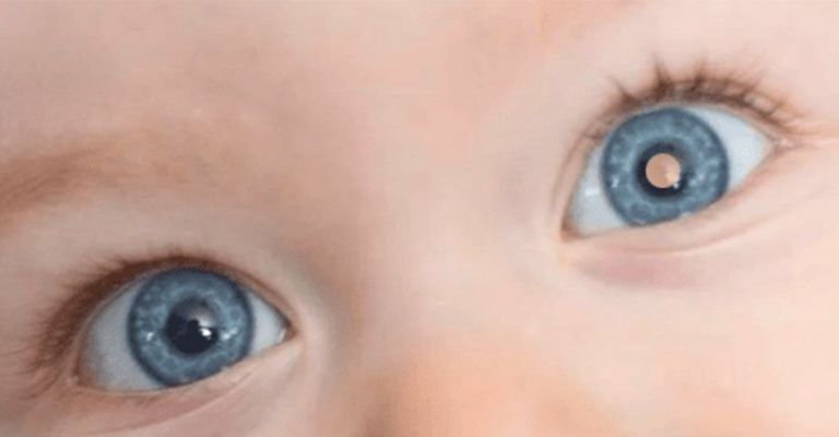 O que é Câncer Retinoblastoma?